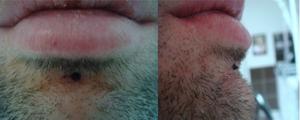dermal labret