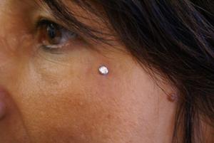 dermal oeil