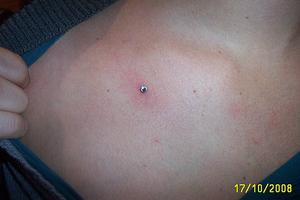 implant à la clavicule