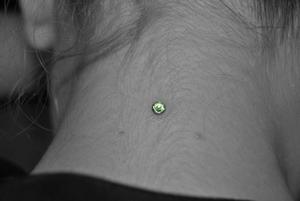 implant nuque