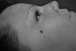 implant visage