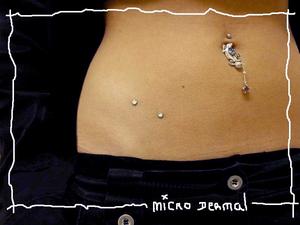 Micro dermal hanche