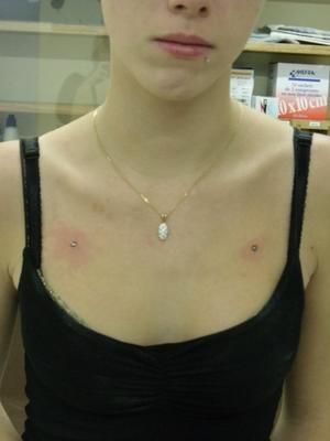 microdermal