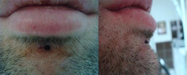 Photo de dermal labret, piercing, labret réalisé par Ultimate Tattoo