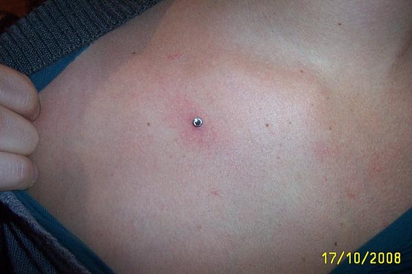 implant à la clavicule