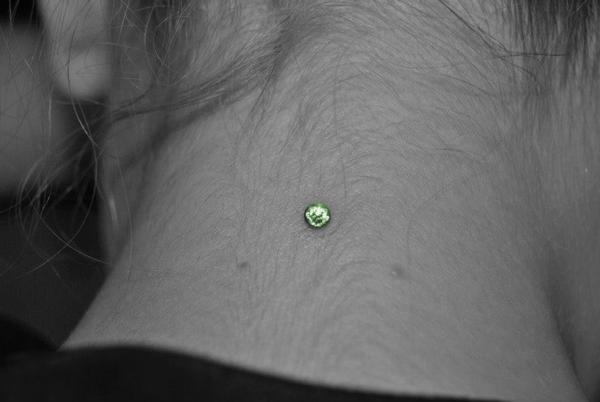 implant nuque