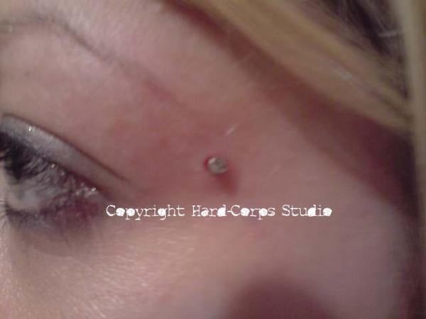 Micro-dermal