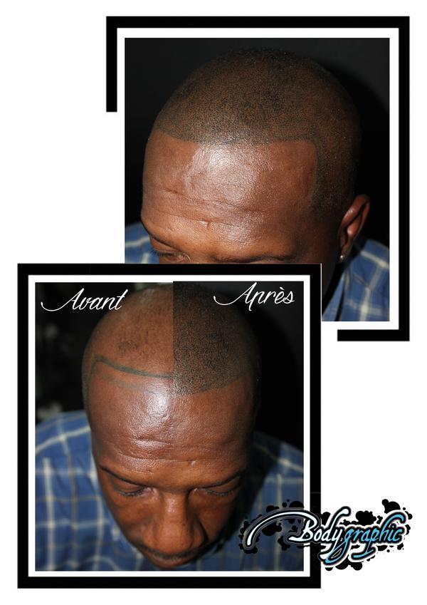 micropigmentation